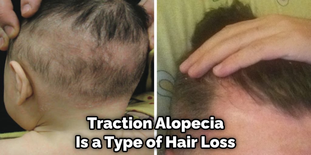 Traction Alopecia Is a Type of Hair Loss