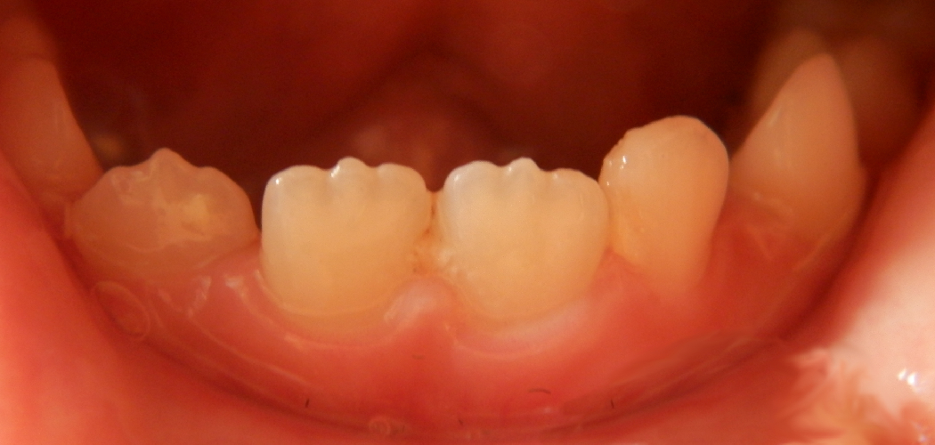 How to Fix Peg Lateral Teeth Apply These 07 Steps! (2024)