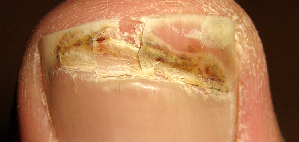 How to Fix a Broken Toenail With Acrylic 15 Easy Steps