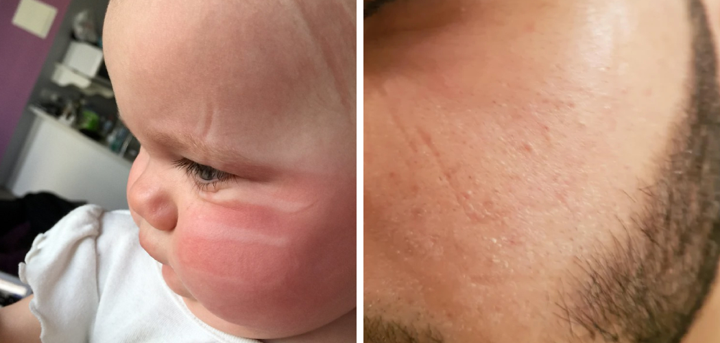 How to Fix Pillow Face Describe in 14 Steps (2024)