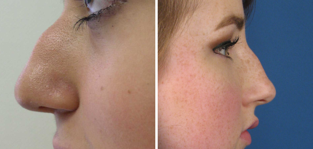 How to Fix Bulbous Nose 8 Effective Ideas (2024)